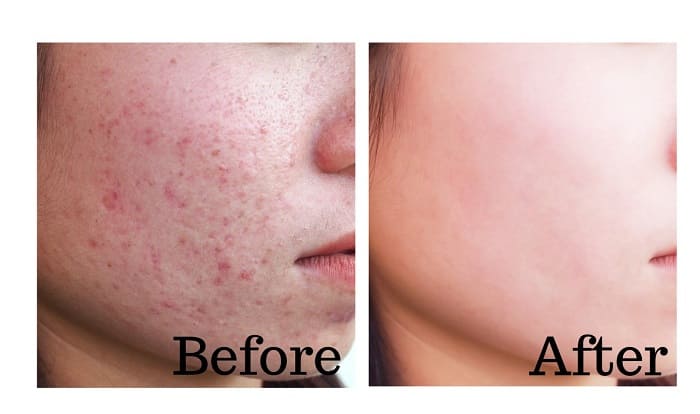 ミレムビュートリック使用前使用後１０